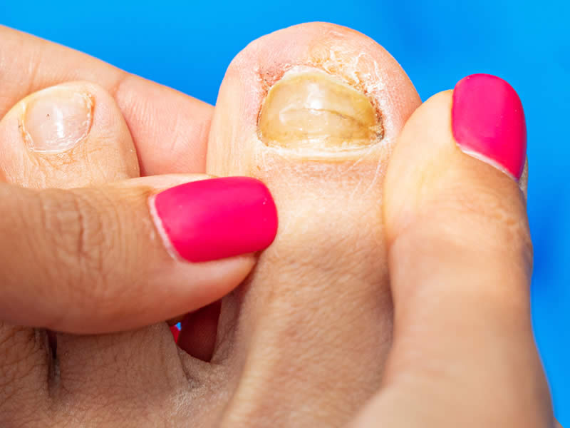 Tratamento de unhas (onicomicose, unha encravada, fragilidade)