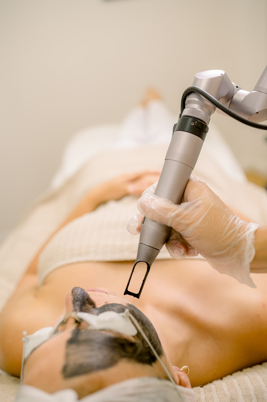 Radiofrequência microagulhada